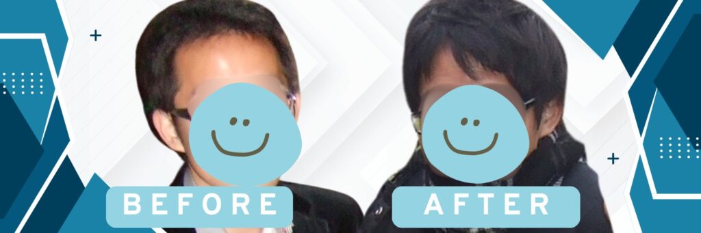 AGA治療前後のビフォーアフター写真