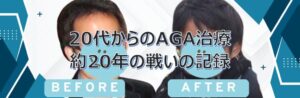 20代で若ハゲに悩み、AGA治療を始めてから20年。効果が出るまでの経過、やめた時の後退、再開後の回復、妊活や費用までリアルに解説。おすすめAGAクリニック比較つき。