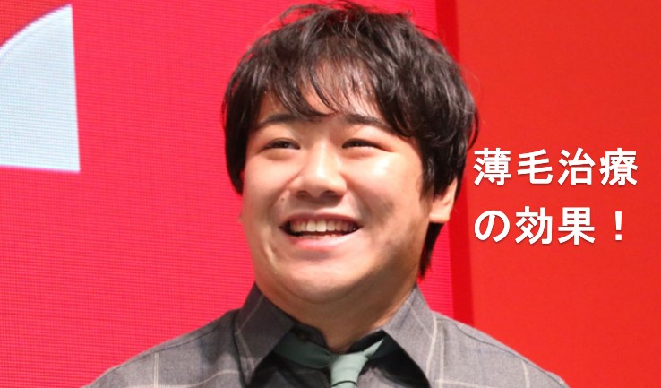 ラランド西田さんに学ぶ！20代の薄毛は放置厳禁！芸人も実践するAGA治療、あなたはどこで始める？